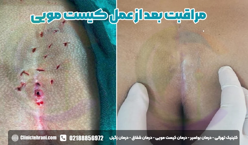 فیلم عمل کیست مویی با لیزر +مراقبت بعد از لیزر کیست مویی