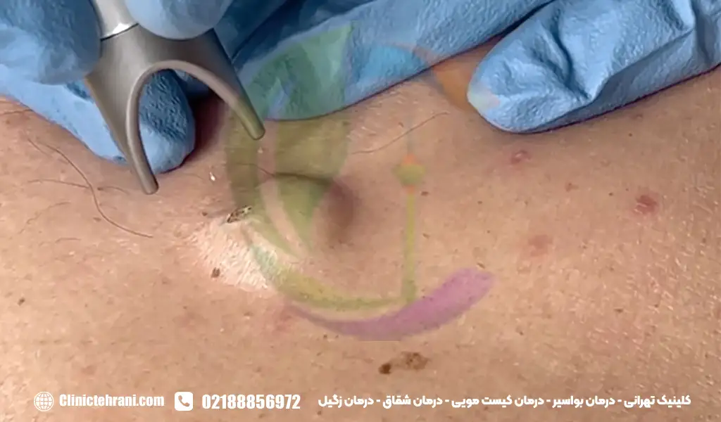 ایا کیست مویی بدون عمل درمان میشود؟