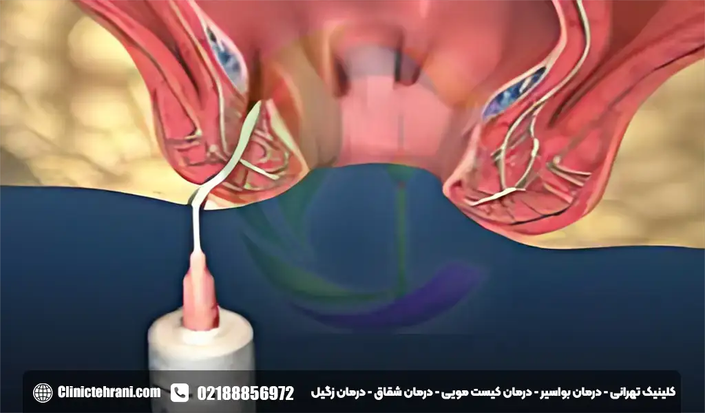 درمان قطعی فیستول مقعدی بدون جراحی
