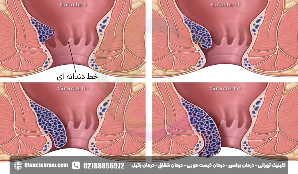 هموروئید داخلی