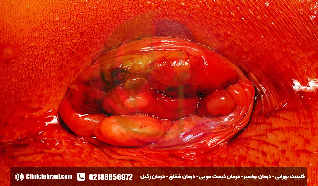 برگشت بواسیر بعد از عمل