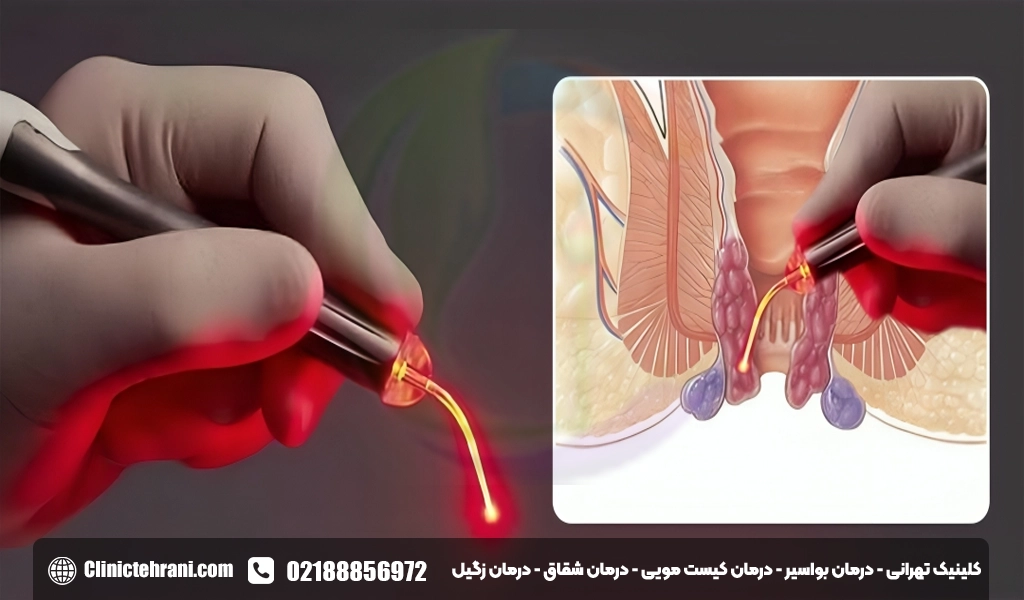 لیزر بواسیر داخلی