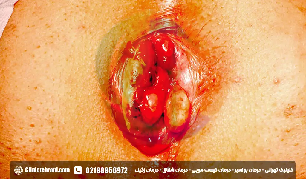 بازگشت بواسیر