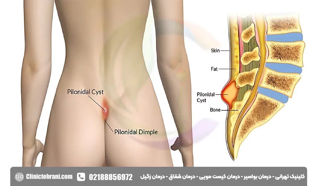 موی برگشتی چیست؟