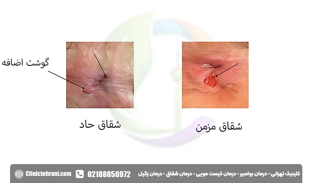 درمان شقاق با طب سنتی