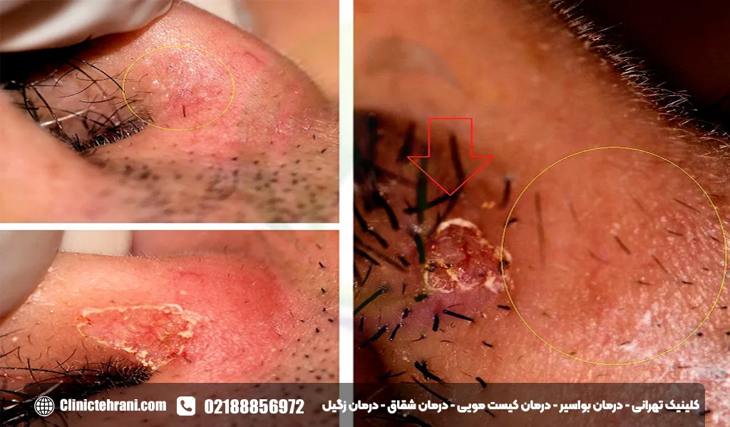 عکس زگیل تناسلی در مردان