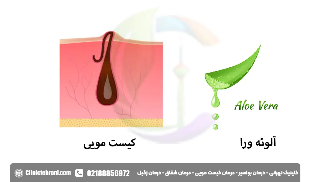 درمان طب سنتی کیست مویی