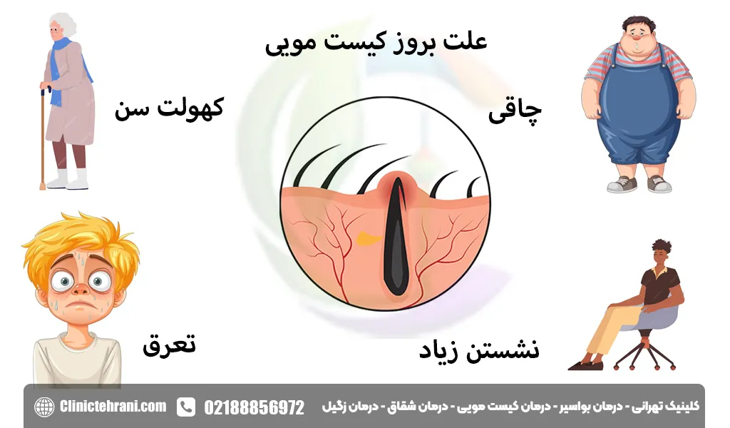 علت بروز کیست مویی