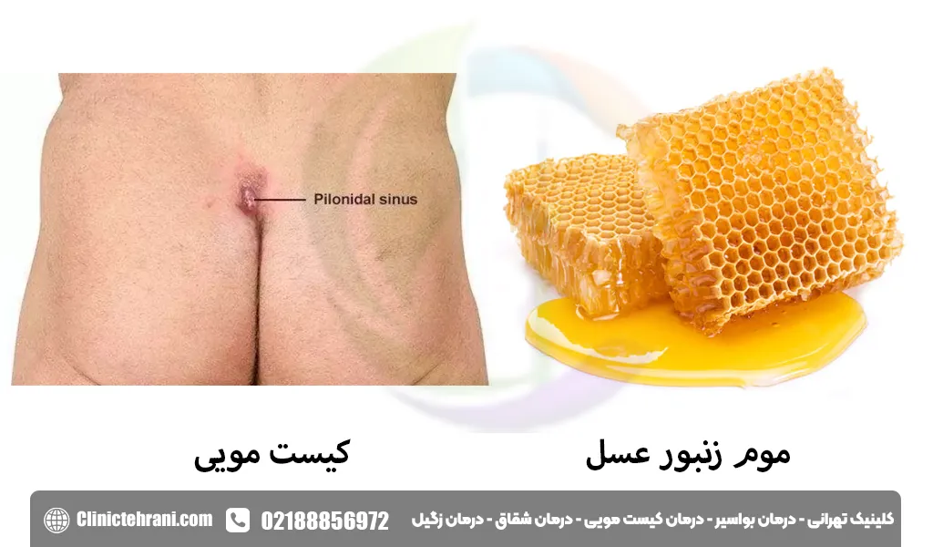 درمان سنتی کیست مویی با عسل
