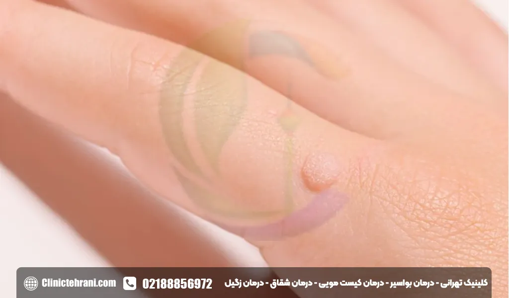 زگیل تناسلی چگونه به وجود میاد