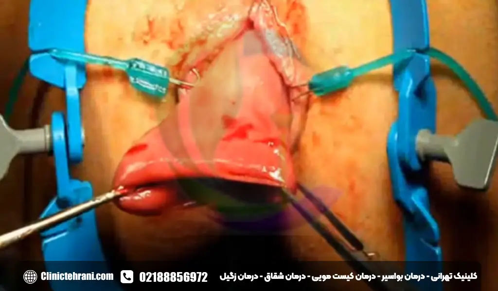 علائم افتادن راست روده چیست