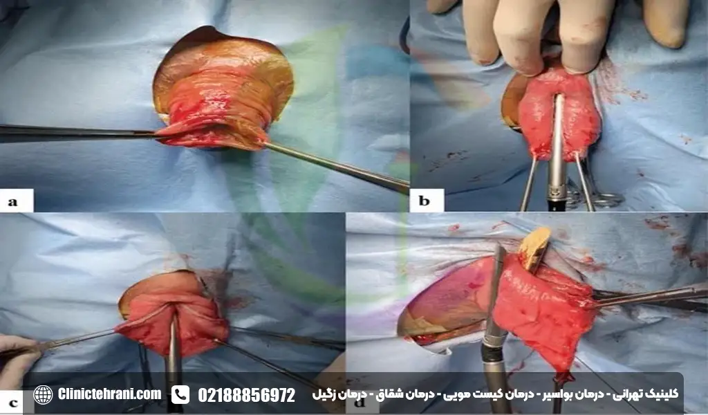 درمان افتادگی راست روده