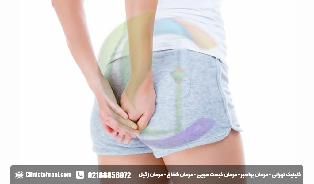 هموروئید در زنان