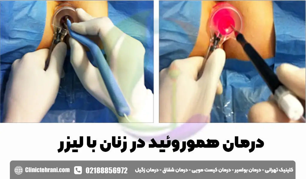 درمان بواسیر در زنان
