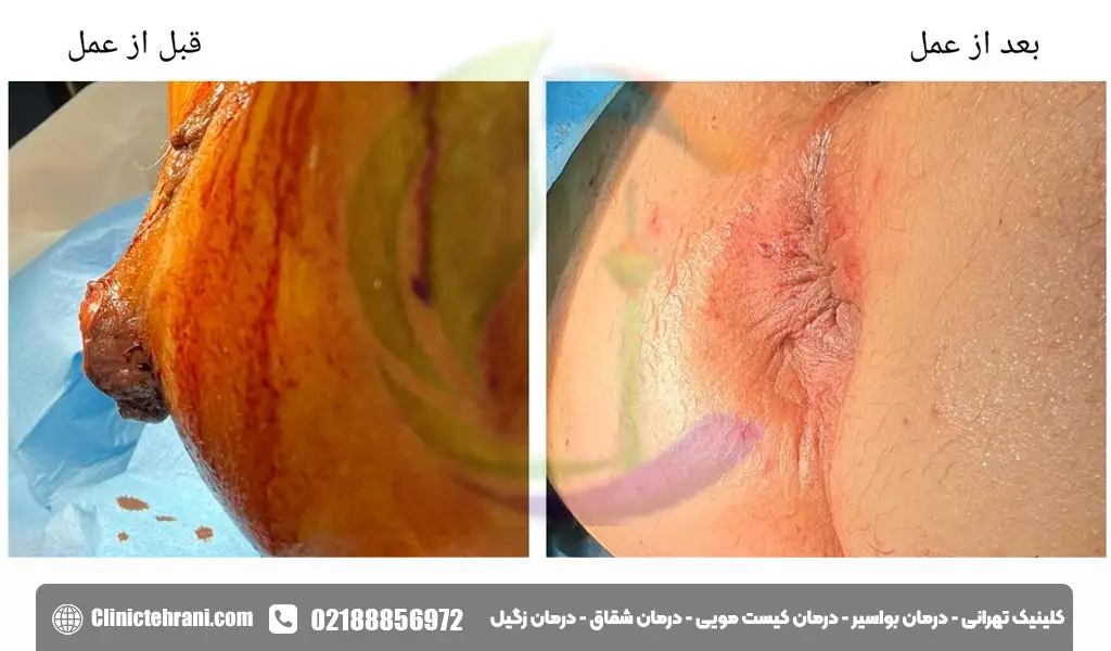 عکس بواسیر در زنان