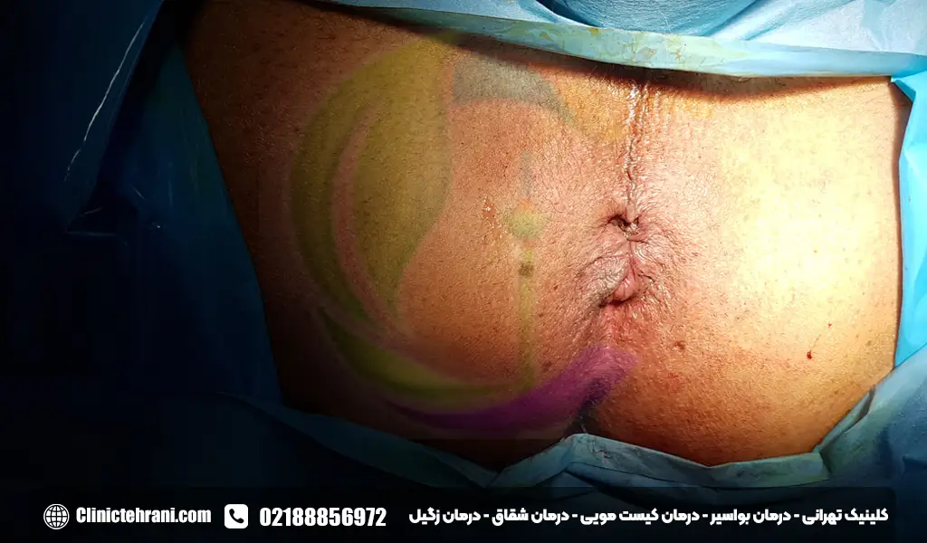 عکس بواسیر خفیف در زنان