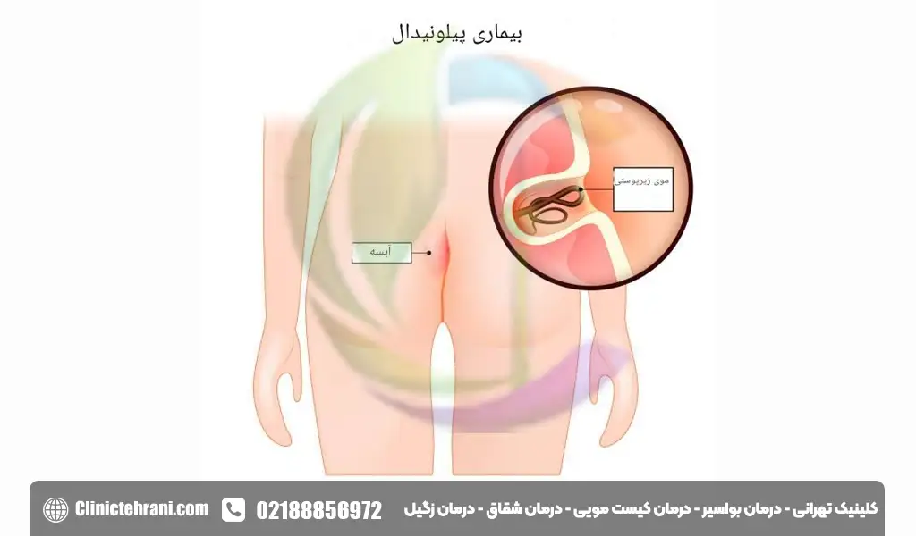 کیست مویی در زنان