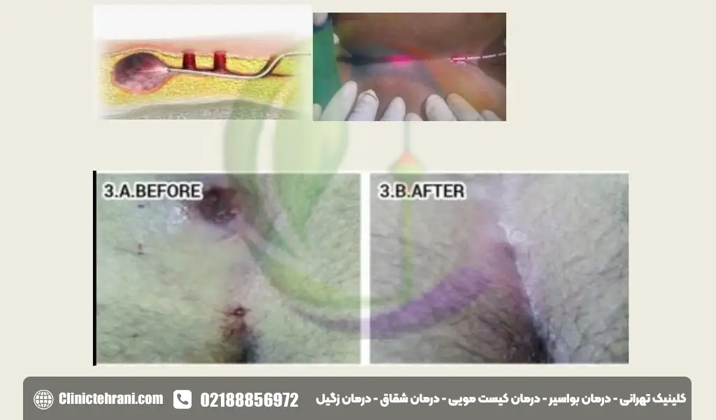 عمل کیست مویی زنان