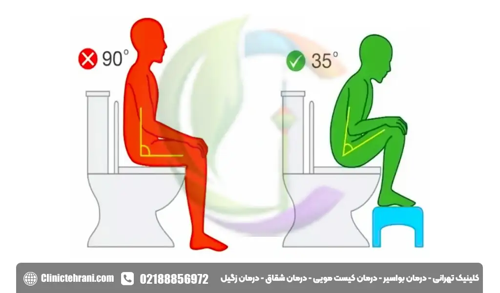 دلیل بواسیر