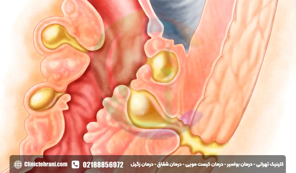علائم فیستول