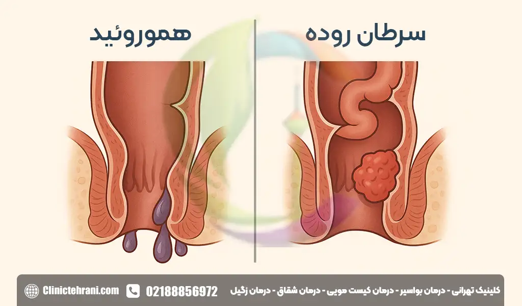 علائم سرطان بواسیر+علائم تومور مقعدی