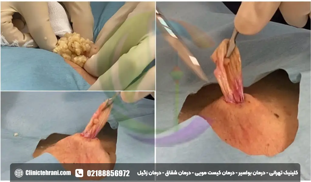 عکس سینوس پیلونیدال