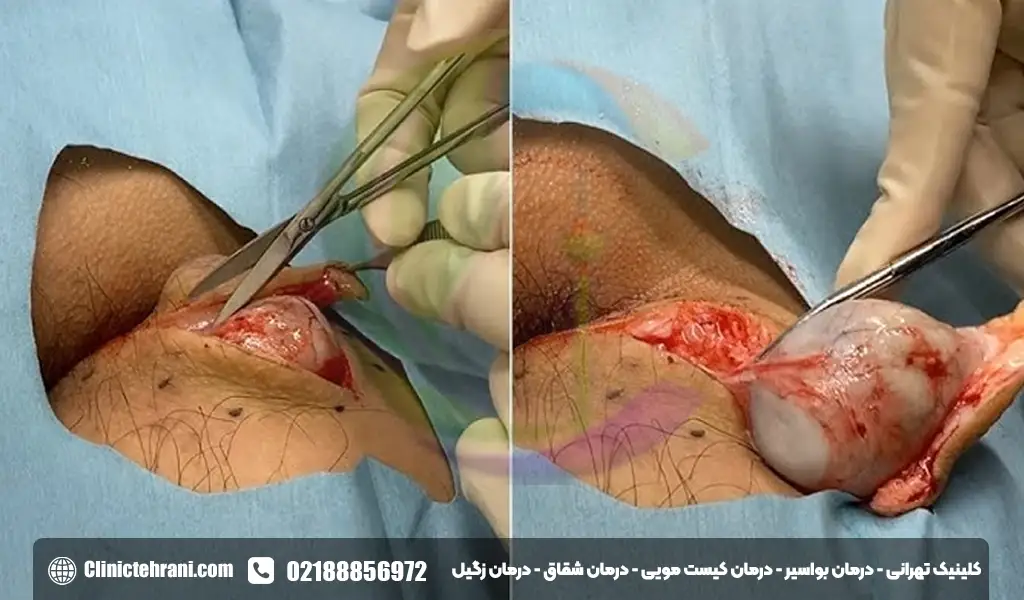 روش های درمانی برای سینوس پیلونیدال