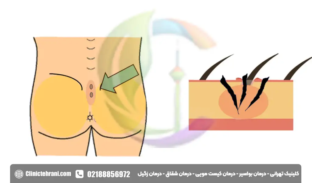 سینوس پیلونیدال
