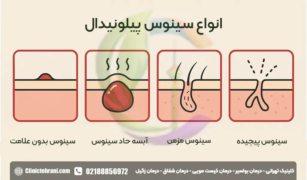 علائم ظاهری کیست مویی