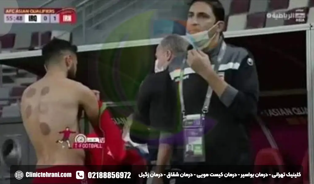 درمان افتادگی روده در طب سنتی