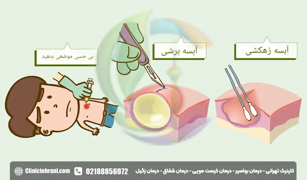 جراحی آبسه مقعدی در کودکان