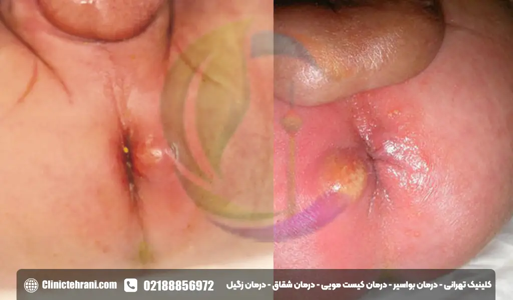 آبسه مقعدی در نوزادان