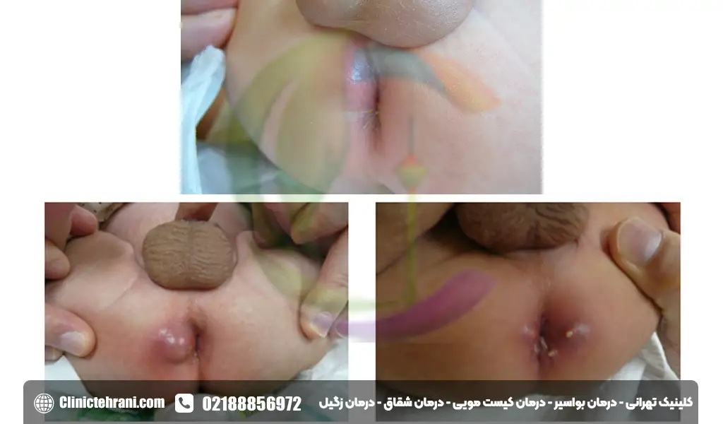 آبسه مقعدی در کودکان