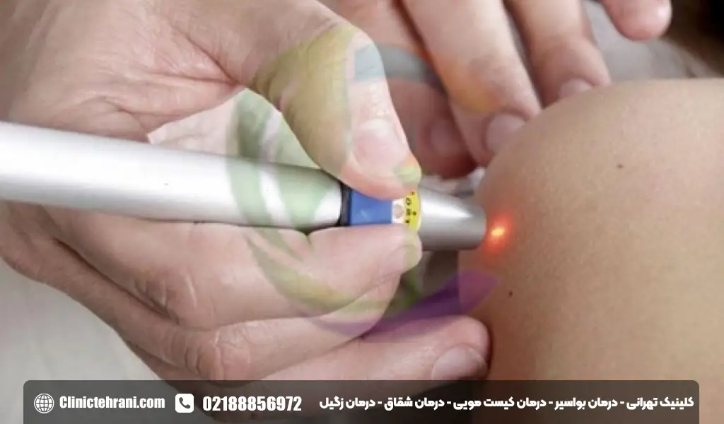 لیزر شقاق در بارداری