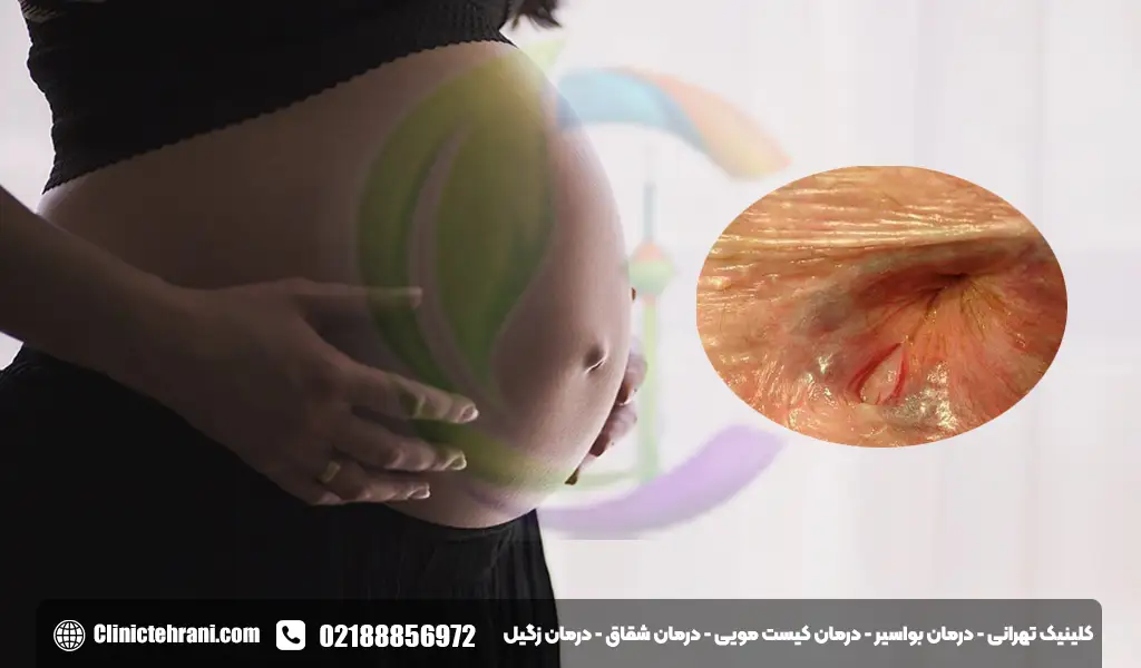 شقاق در بارداری