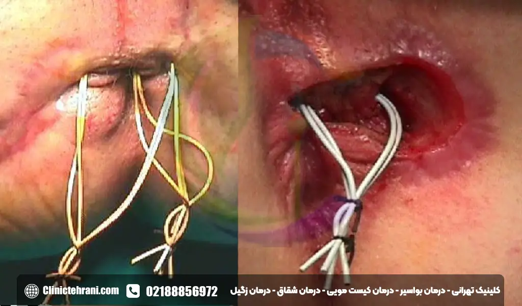 عوارض بعد از عمل آبسه مقعدی