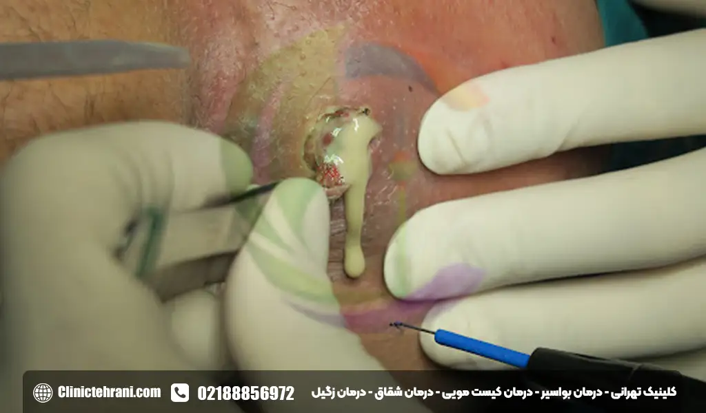 ترشحات بعد از جراحی آبسه مقعدی 