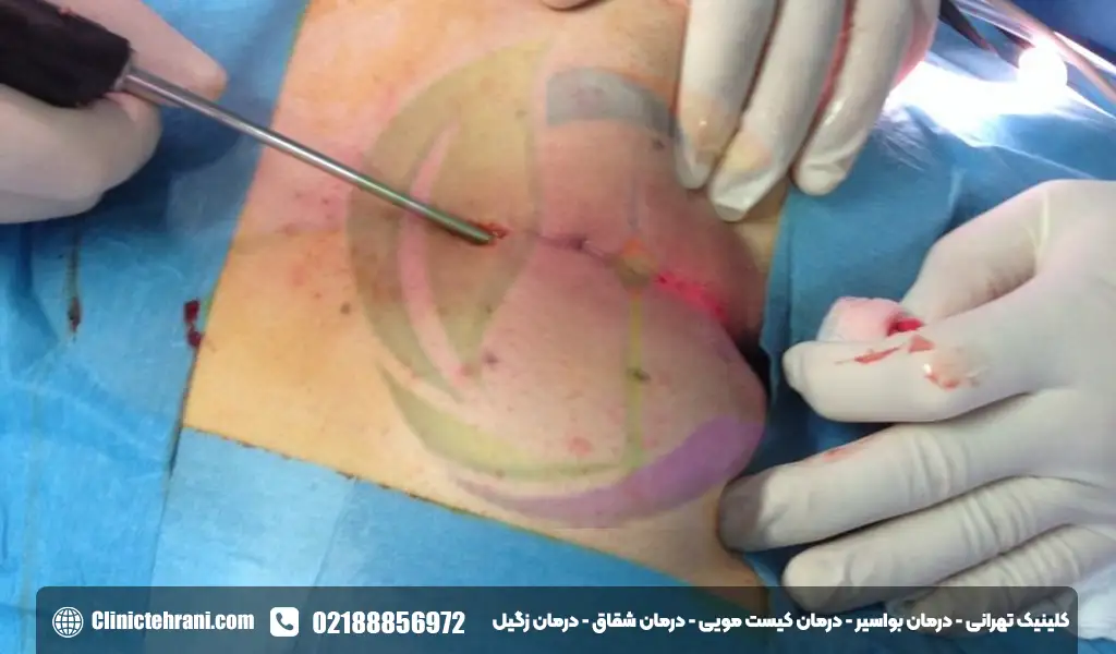 جراحی آبسه مقعدی