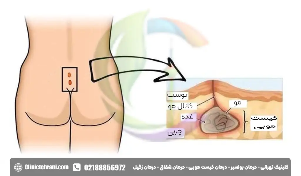 دلایل بروز کیست مویی چیست