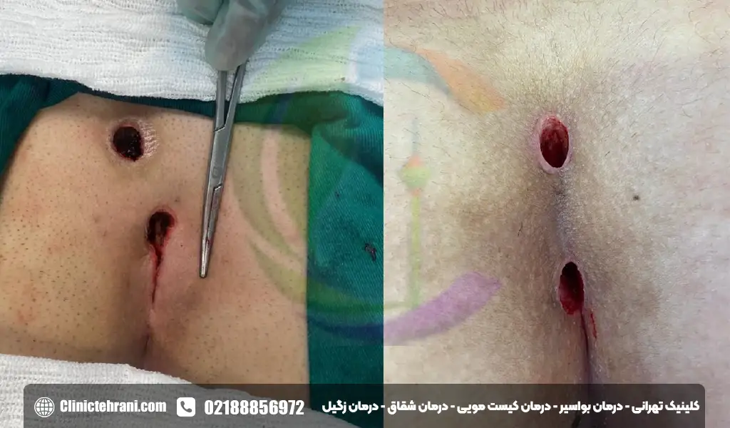 عکس کیست مویی
