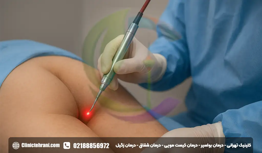 درمان شقاق مقعدی با لیزر