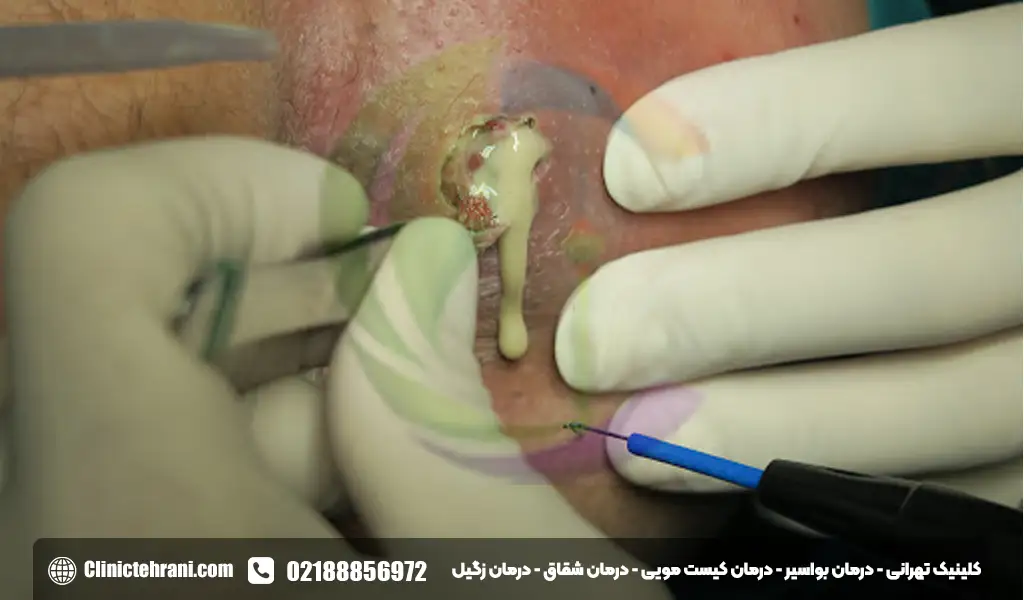عکس عفونت مقعدی