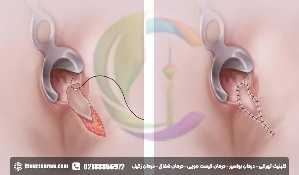 عکس شقاق بعد از عمل