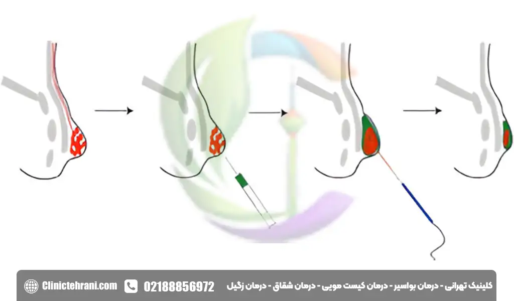 لیزر بواسیر