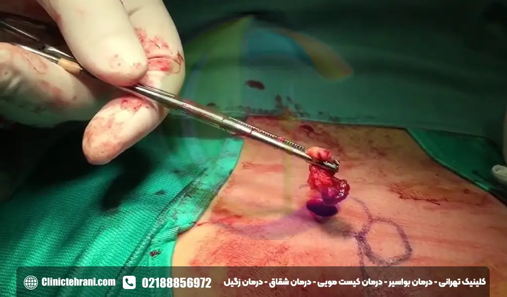 عمل کیست مویی