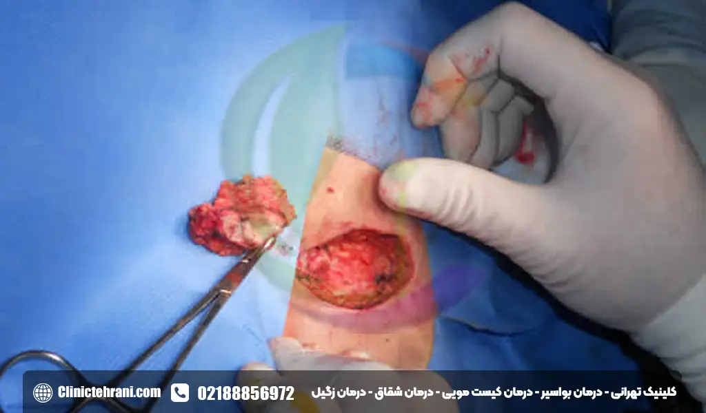 عکس عفونت کیست مویی بعد از عمل