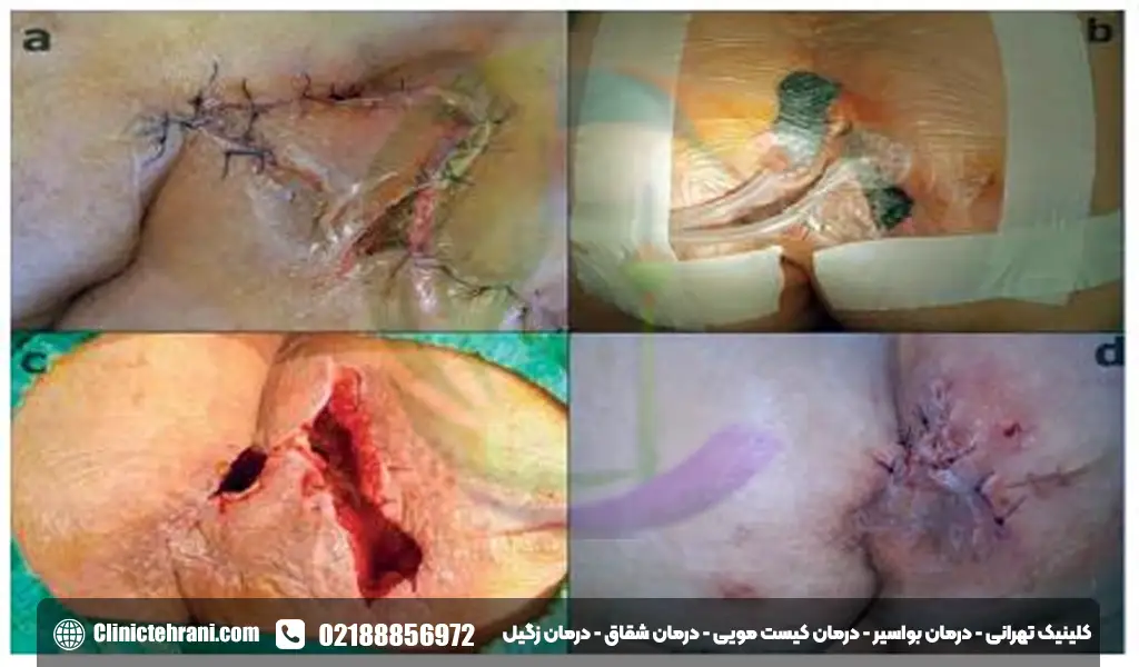 عمل کیست مویی بسته