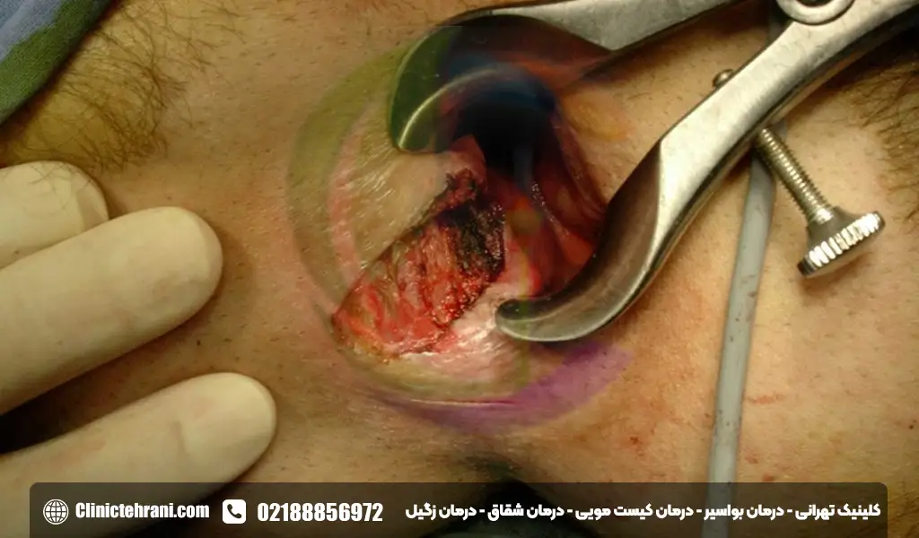 لیزر آبسه مقعدی