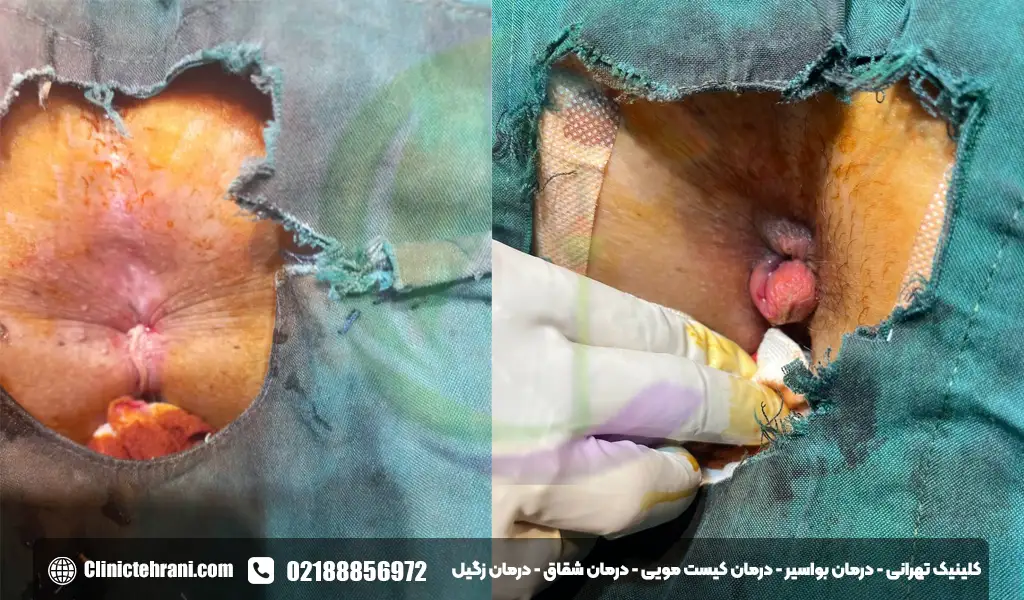 عکس قبل و بعد از عمل لیزر بواسیر