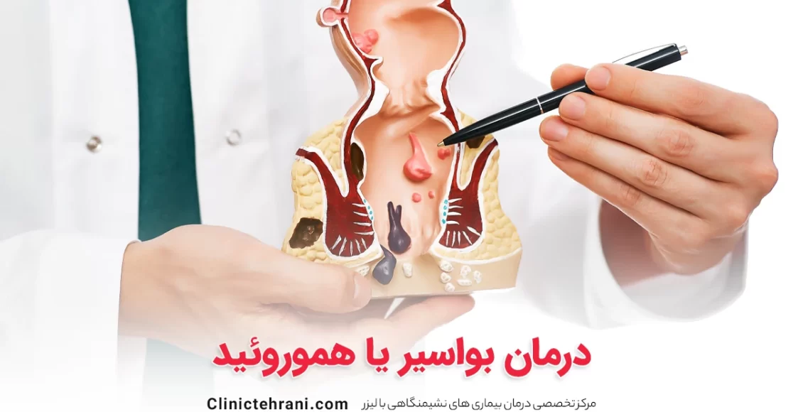درمان بواسیر یا هموروئید